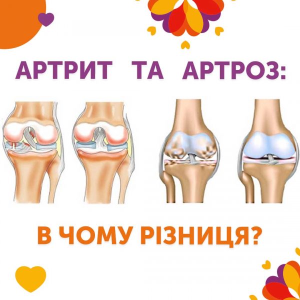 Артрит чи артроз: в чому різниця?