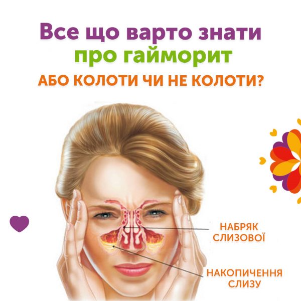 Все що варто знати про гайморит