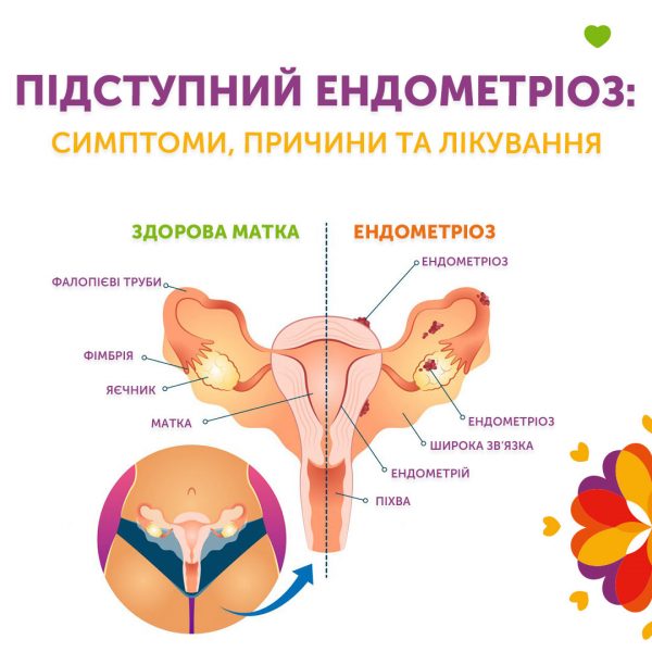 Підступний ендометріоз: симптоми, причини та лікування