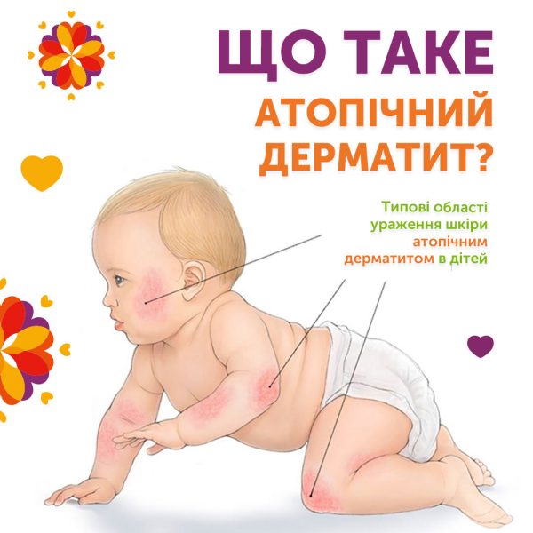 Що таке атопічний дерматит?