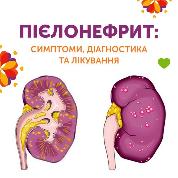 Пієлонефрит: симптоми, діагностика та лікування