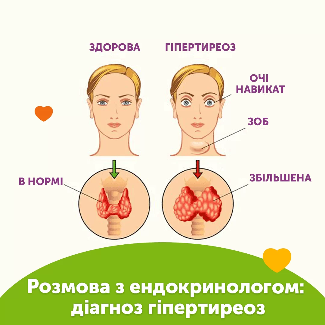 Розмова з ендокринологом: діагноз гіпертиреоз