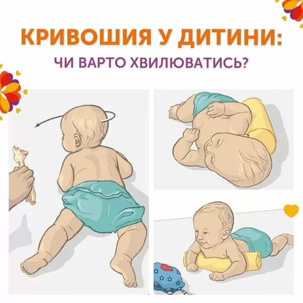 Кривошея у ребенка: стоит ли волноваться?