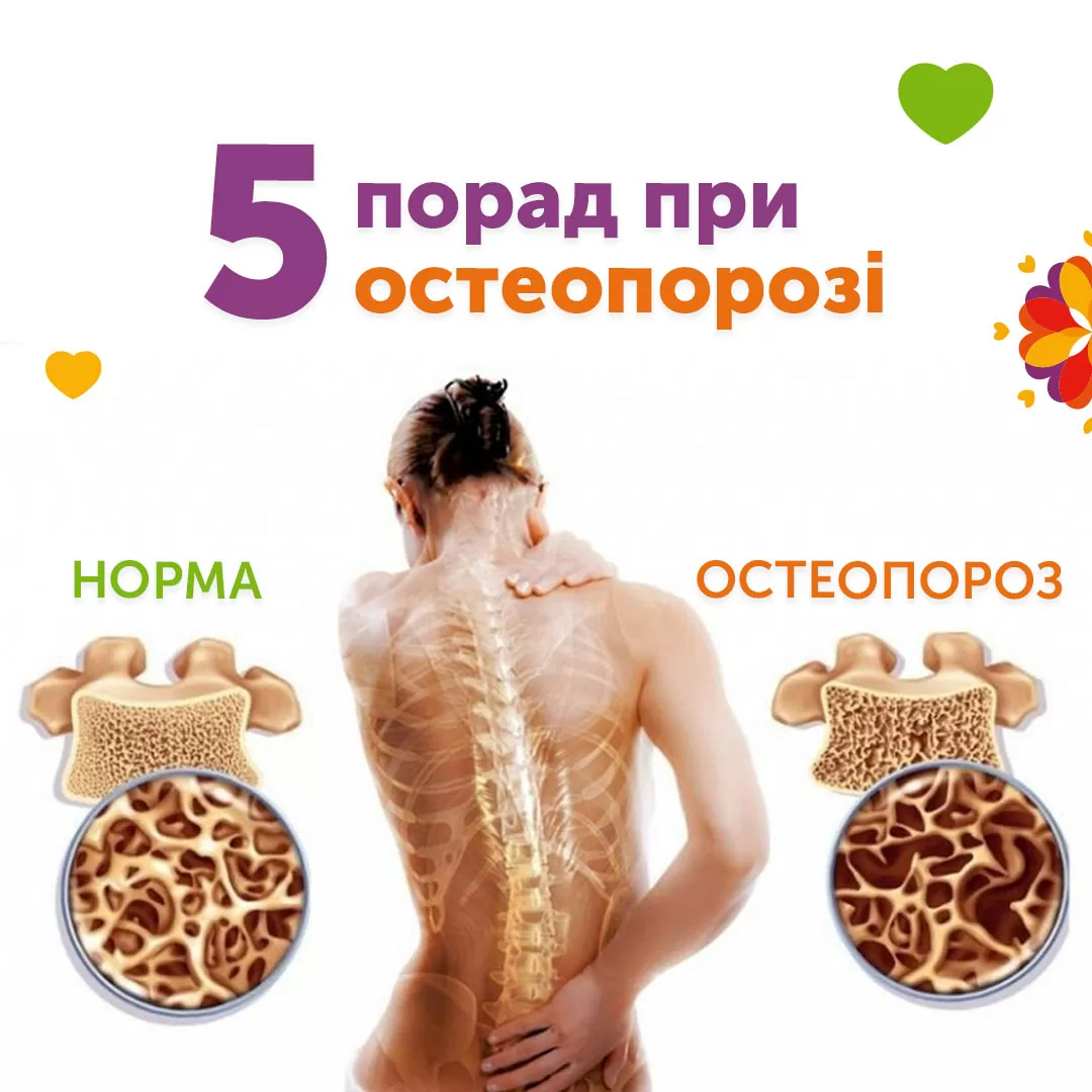 5 советов при остеопорозе