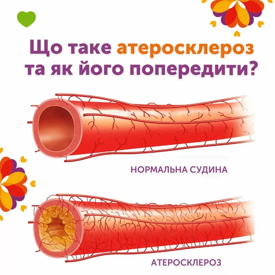 Що таке атеросклероз та як його попередити?