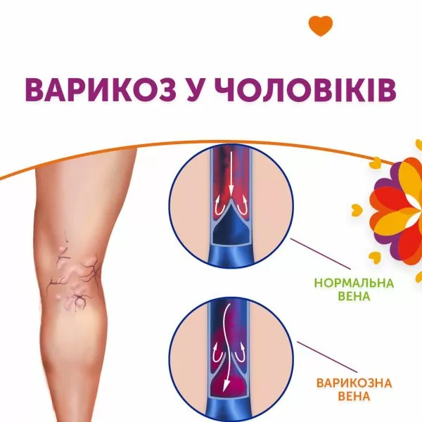Варикоз у чоловіків